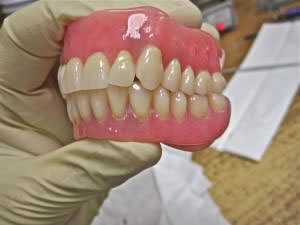 Your Denturist can guide you as to when the situation warrants immediate dentures.