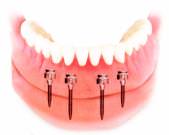 Dental implants can help provide the closest possible replacement for natural teeth, and the best way to restore your natural smile.